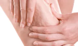 Prof. Dr. Karacalar'dan selülit uyarısı: Portakal kabuğu görüntüsü basit sorun değil!