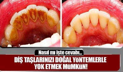 Diş taşlarını bu yöntemlerle yok etmek mümkün...